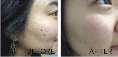 Tags & Moles Remover