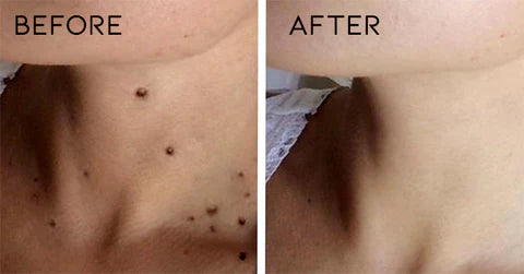 Tags & Moles Remover